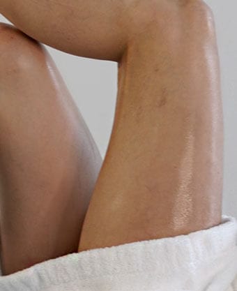 Glamoi Med Spa - Spider Vein Treatments Manhattan - Spider Vein - Spider Vein Treatments NYC