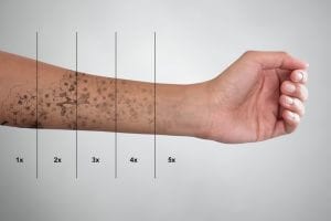 stages of tattoo removal on an arm