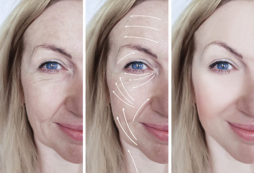 woman facial wrinkles correction before and after procedures arrow - Skin Tightening