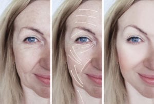 woman facial wrinkles correction before and after procedures arrow - Skin Tightening