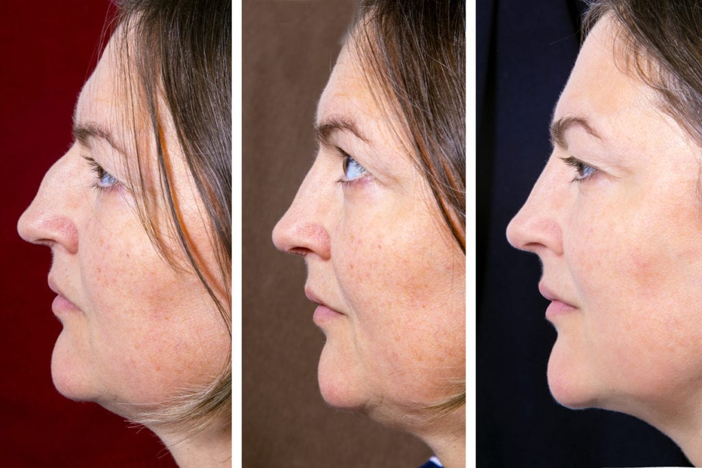 Kybella Injections - Profile portrait of adult woman with plastic surgery of the nose and double chin - situation BEFORE and AFTER