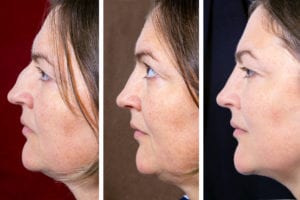 Kybella Injections - Profile portrait of adult woman with plastic surgery of the nose and double chin - situation BEFORE and AFTER