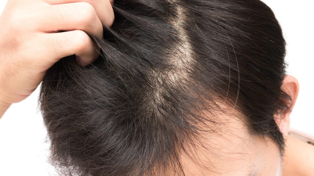 Young man serious hair loss problem - Stem Cell and PRP Therapy